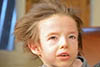 معلومات عن متلازمة مينكيس ” Menkes syndrome “