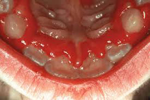 صورة: التهاب اللثة عند الأطفال Gingivostomatitis