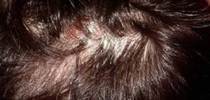 أجزاء الشعر ومكوناته و التهاب بصيلات الشعر صورة: أجزاء الشعر ومكوناته و التهاب بصيلات الشعر