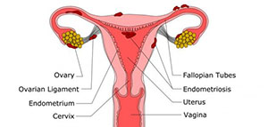 صورة: بطانة الرحم المهاجرة و أعراض بطانة الرحم المهاجرة