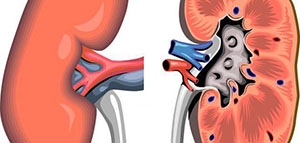صورة: الفشل الكلوي و أعراض الفشل الكلوي و أسباب الفشل الكلوي[d]14
