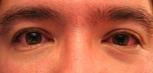 صورة: الرمد الربيعي و أسباب الرمد الربيعي و أعراض الرمد الربيعي