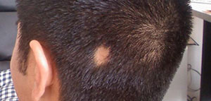 صورة: أمراض فروة الرأس و أمراض تؤدي إلى تساقط الشعر