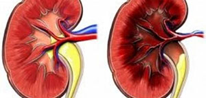 صورة: تليف الكلى و علاج تليف الكلى و أعراض مرض الكلى المزمن