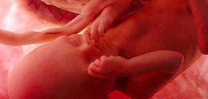 صورة: التفاف الحبل السري حول رقبة الجنين و فيديو عن التفاف الحبل السري حول رقبة الجنين