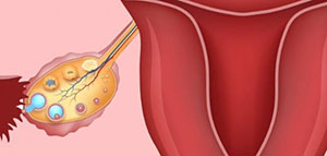 صورة: علاج ضعف البويضات و أسباب ضعف البويضات