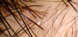 صورة: بصيلات الشعر و أسباب ضعف نمو بصيلات الشعر