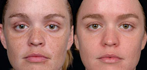 صورة: تقشير البشرة بالليزر و حالات التقشير بالليزر