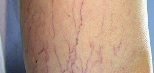 صورة: دوالي الساقين و أعراض دوالي الساقين و أسباب الإصابة بدوالي الساقين