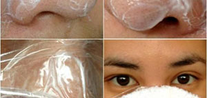 صورة: الرؤوس السوداء و وصفات طبيعية للتخلص من الرؤوس السوداء