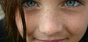 صورة: النمش و وصفات طبيعية لعلاج النمش و علامات الجمال