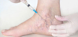 كيف يتم علاج الدوالي عند النساء و ماذا عن التدابير المنزلية للتخلص من الدوالي صورة: كيف يتم علاج الدوالي عند النساء و ماذا عن التدابير المنزلية للتخلص من الدوالي