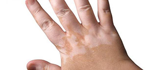 صورة: علاج البرص و الدعم النفسي والاجتماعي