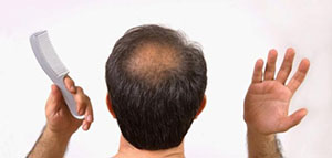 صورة: فراغات الرأس و أسباب ظهور فراغات في فروة الرأس