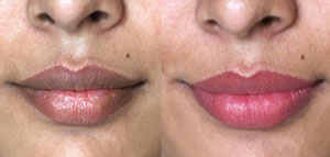 صورة: الشفاه و وصفات لإزالة سواد الشفاه و نصائح للحفاظ على شفاه وردية