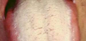 صورة: ما هي فطريات الفم واللسان و ما هي الأعراض التي تدل على الإصابة بفطريات الفم