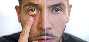 صورة: فقر الدم و الاضطراب العاطفي و الصدمة