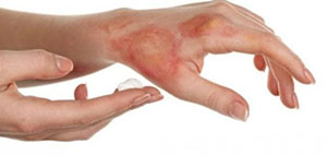 صورة: ما هي آثار الحروق و كيف يمكن التخلص من آثار الحروق