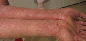 صورة: مرض الزهري و علاج الزهري و طرق انتقال مرض الزهري