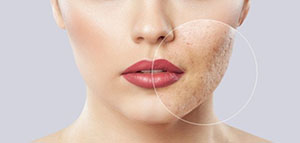 صورة: حفر الوجه و متى يمكن أن تظهر حفر الوجه