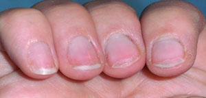 صورة: تكسر الأظافر و أسباب تكسر الأظافر و علاج تكسر الأظافر