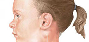 صورة: الغدد الليمفاوية و أين تقع الغدد الليمفاوية