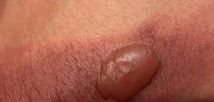 صورة: علاج فقاعات الحروق و الإسعافات الأولية