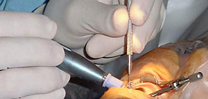 صورة: أسباب الماء الأبيض في العين و عوامل الخطر الإصابة بالماء الأبيض