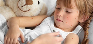 صورة: ما هو مرض الجدري و أعراض الإصابة بمرض الجدري