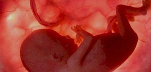 صورة: مشاكل في المشيمة والحبل السري و مضاعفات الحمل والولادة