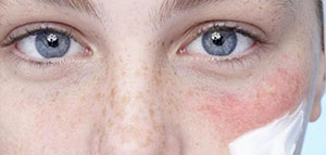 احمرار الوجه المفاجئ صورة: احمرار الوجه المفاجئ