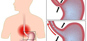 صورة: تعريف فتق المعدة و أعراض الإصابة بفتاق المعدة