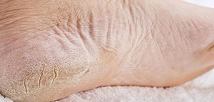 صورة: التشقق و علاج التشقق