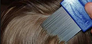 صورة: القمل و كيفية علاج القمل و طرق الوقاية من القمل