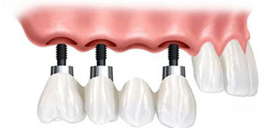 صورة: مقدمة و فوائد زراعة الأسنان و كيف تتم زراعة الأسنان