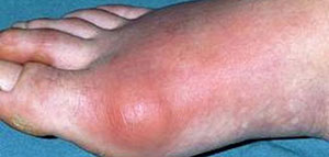 صورة: النقرس و أعراض الإصابة بمرض النقرس و أسباب الإصابة بمرض النقرس