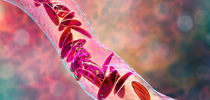 صورة: فقر الدم[d]20