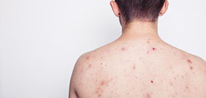 صورة: علاج آثار حبوب الظهر والكتف و سبب ظهور آثار حبوب الظهر والكتف