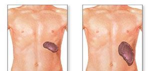 صورة: التهاب الكبد و التنكس الدهني و السرطان