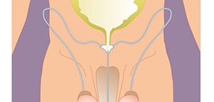 صورة: ما المقصود بالخصية الهاربة و ما هي أسباب التي تؤدي إلى الإصابة بالخصية الهاربة