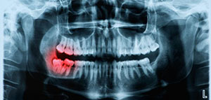 صورة: فيديو عن ضرس العقل