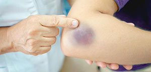 صورة: ما سبب ظهور كدمات في الجسم بدون سبب و سبب تغير لون الكدمات