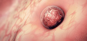 صورة: أعراض نزيف الانغراس و التشنجات و أعراض أخرى